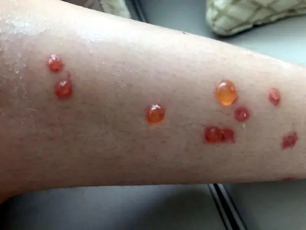 Cantaridina de meloidos: el agente que causa irritación en la piel